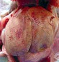 דלקת כבד עם גופיפי הסגר - מחלות מתפרצות מחדש